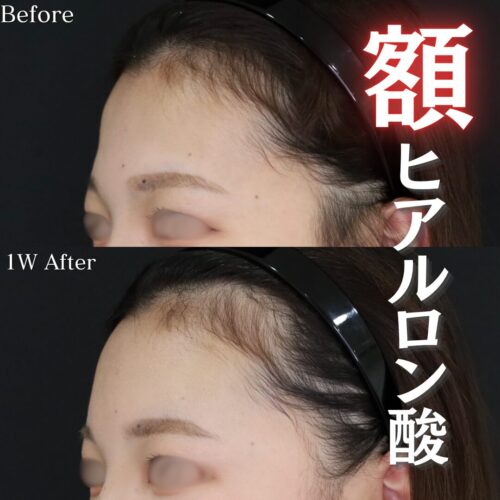 額　ヒアルロン酸注入　症例